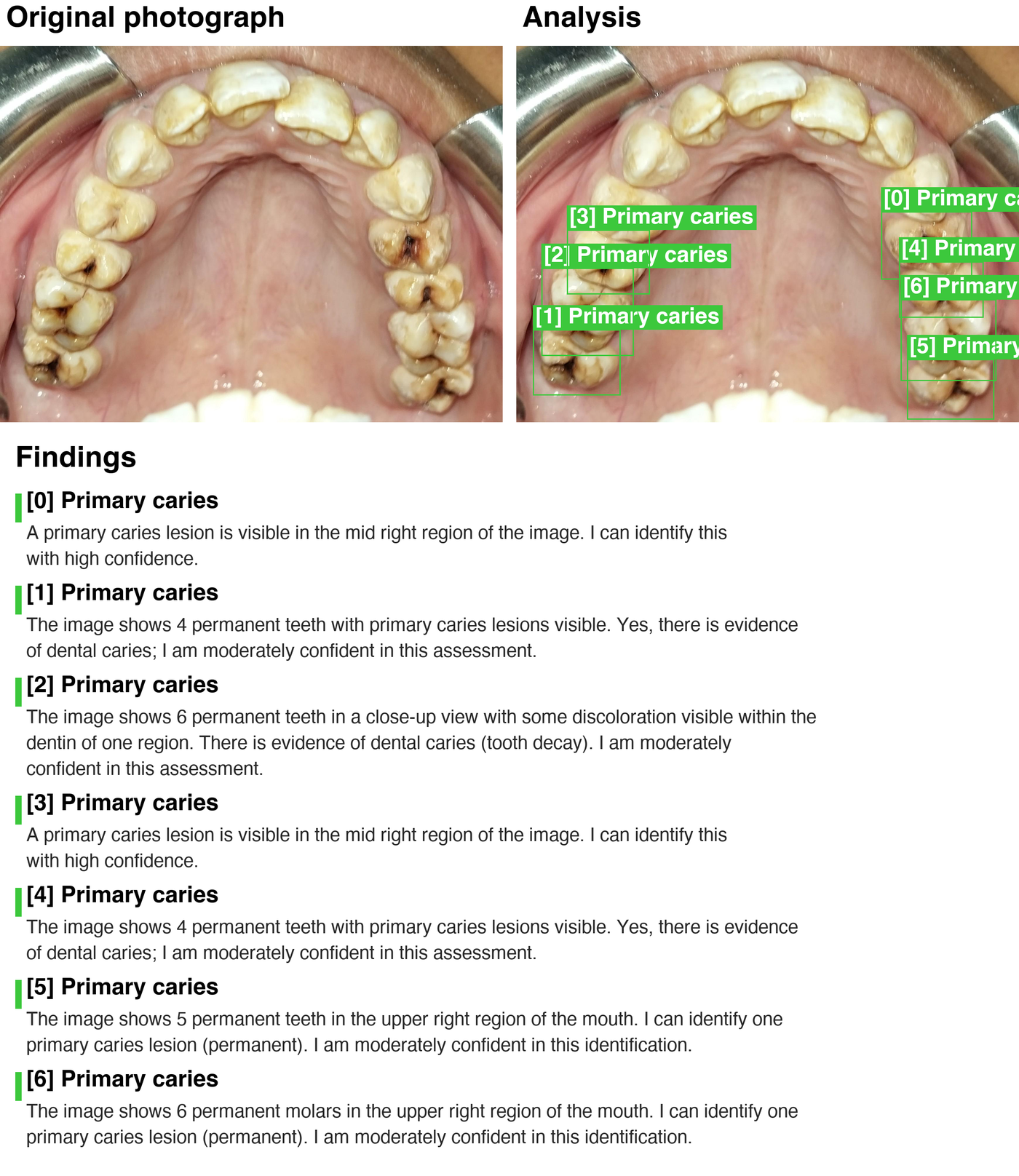 Pipeline output panel — maxillary occlusal photograph with five confirmed caries lesions annotated by YOLO and validated by MedGemma with per-lesion clinical rationale.