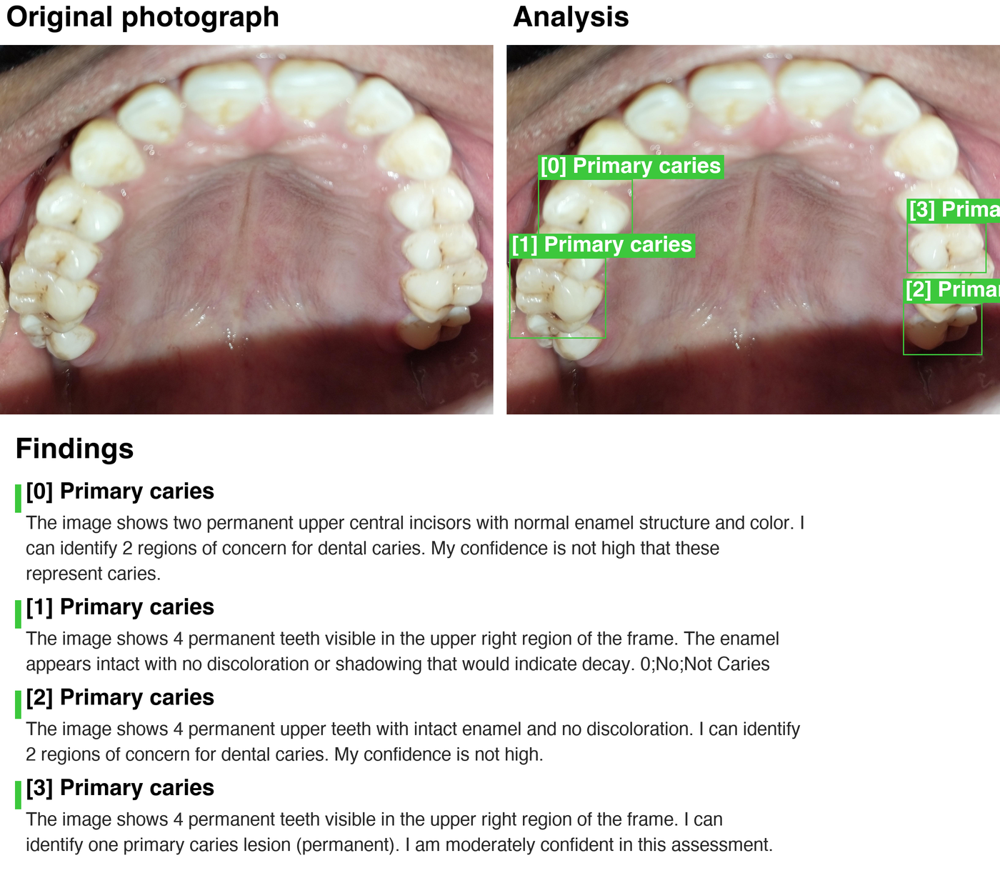 Pipeline output panel — complex real-world case with three lesion detections and mixed verdicts, each carrying an individual MedGemma clinical note beneath the annotated image.