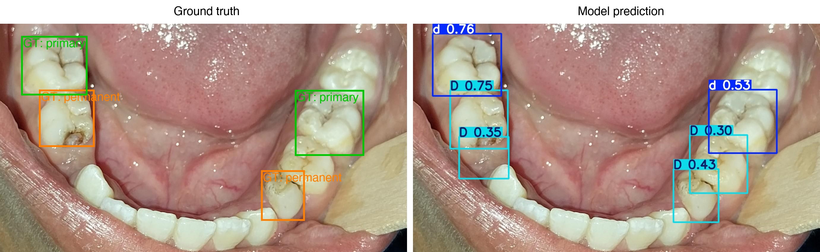 DentalAuto vision — YOLO11m + MedGemma inference demo.